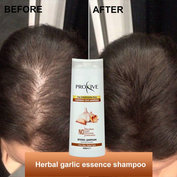 PROXIVE Anti-Hair Loss Herbal Garlic Shampoo - Image 4
